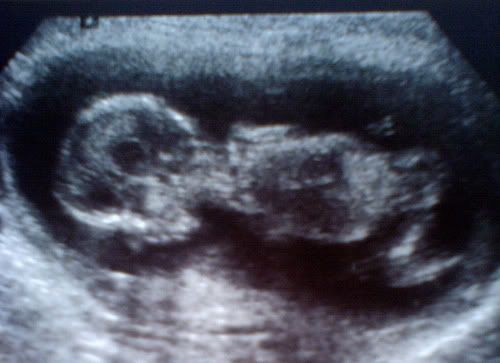 foetus.jpg