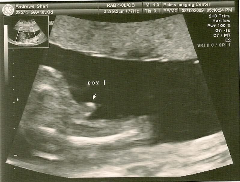 13 weeks pregnant. 13 WEEKS PREGNANT ULTRASOUND