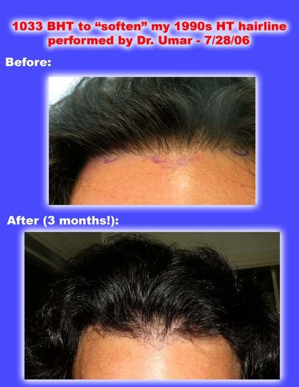 Birthmark In Hair. crown irthmark,then hair